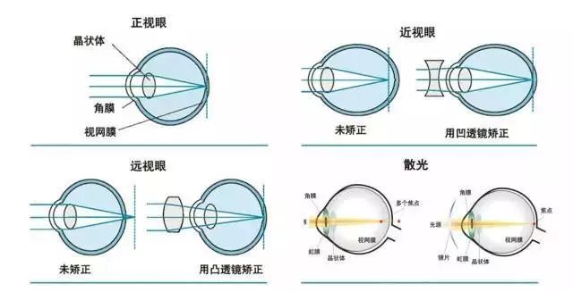 屈光不正戴眼镜可以矫正吗,关于屈光不正的矫正与实地分析数据应用,深入应用解析数据_3DM19.30.66