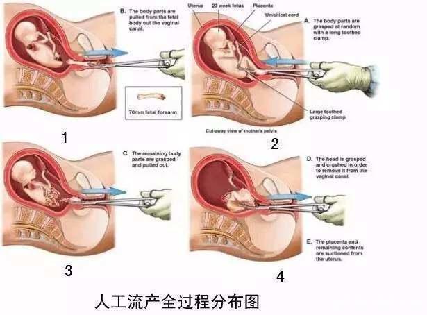 无痛引产真的不痛吗引产要多久,无痛引产，全面解析疼痛感受与过程时长,持久性计划实施_出版社44.89.64